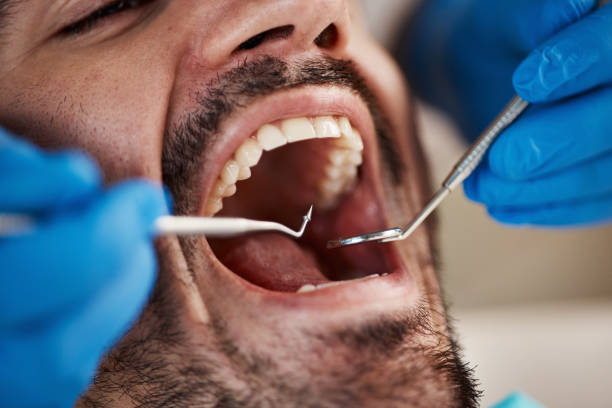Best Emergency Dentist for Lost Fillings or Crowns in Mineralwells, WV